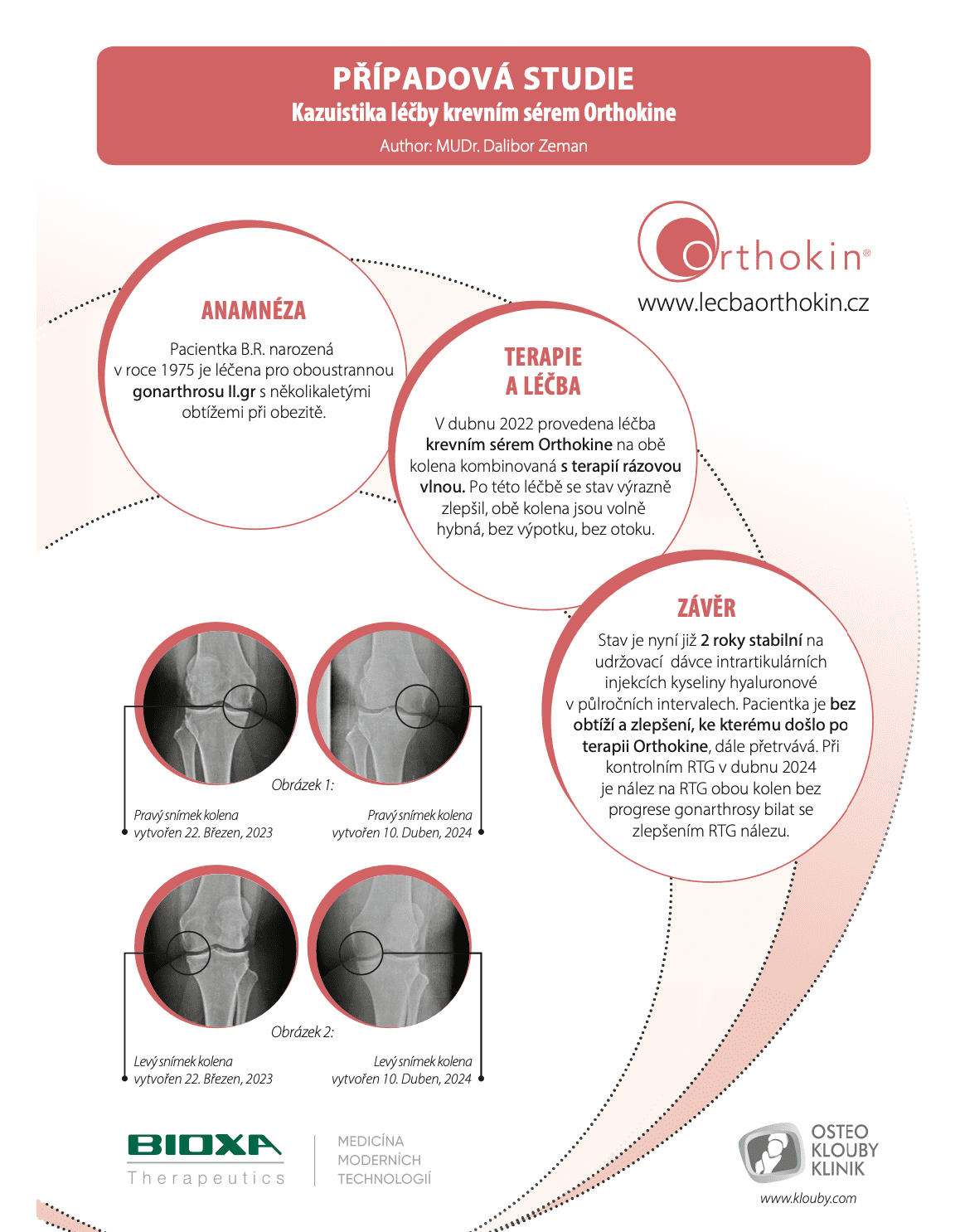 Léčba krevním sérem Orthokine - případová studie