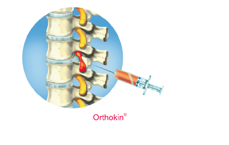 Jak funguje léčba metodou Orthokine